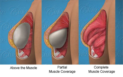 3 Types of Muscle Coverage