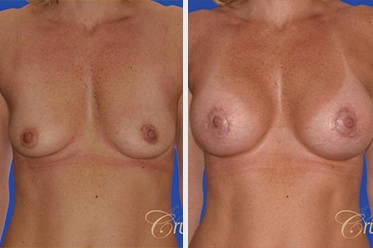 breast lift recovery before and after orange county ca